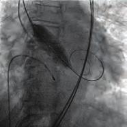 OPS-076 TAVI, valve pop-out and left main occlusion in the same patient Erdem Karaçöp, Asım Enhoş, Nijat Bakshsaliyev, Nuray Kahraman Ay, Ziya İsmayiloğlu, Mustafa Ahmet Huyut, Mahmut Uluganyan,