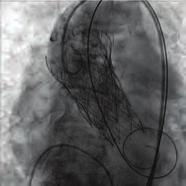 transcatheter aortic valve implantation (TAVI) can be classified as cardiac vs. non-cardiac.