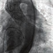 This report describes two complications including valve pop-ouy and left main occlusion in the same patient. Case: A 8-year-old woman admitted to our institution for severe aortic stenosis.