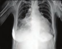 Kardiyak görüntüleme / Ekokardiyografi Kardiyak görüntüleme / Ekokardiyografi Figure. Chest radiography showed pleural effusions. Figure 3.