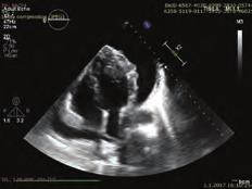 Dimensional echocardiographic showed metastatic nodular involvement in mid to apical left ventricle myocardium and pericardial effusion.