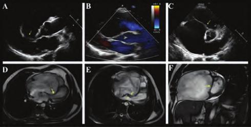 Physical examination revealed a blood pressure of 75/0 mm Hg with tachypnea (4/min.), apical holosystolic murmur and elevated jugular venous pressure.