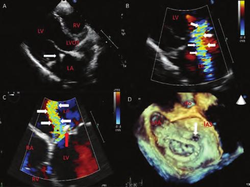 TTE indicated left ventricle systolic dysfunction with an estimated ejection fraction of 45%, a mild dilated left ventricle with global wall hypokinesis and a severe mitral regurgitation due to