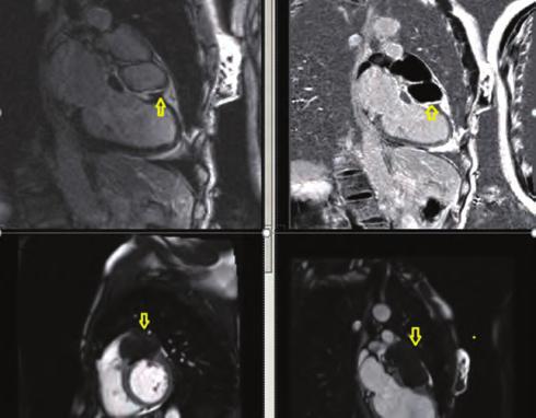 Electrocardiogram revealed 0.5 mm st depression in the inferior leads (II, III and avf). Transthoracic echocardiography showed a mass compressing the anterior wall of the left ventricle externally.