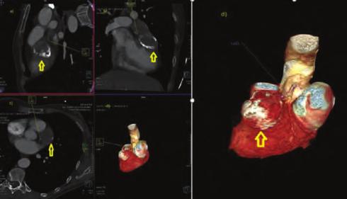 The patient underwent a technetium-99m stress test,which was positive for reversible myocardial ischemia. Subsequently, a coronary angiogram was done.