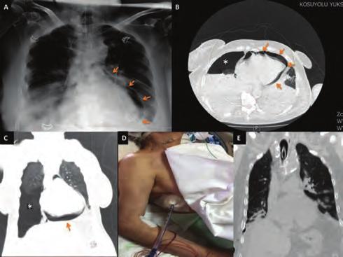 Kardiyak görüntüleme / Ekokardiyografi Pulmoner hipertansiyon / Pulmoner vasküler hastalık Figure 3. Left sided selective pulmonary angiography which shows severe tortuosity Figure 4.