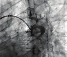 Because of severe multiple tortuosities, the patient was assessed as inoperable by surgeons and pulmonary arterial invasive intervention is planned for the patient.