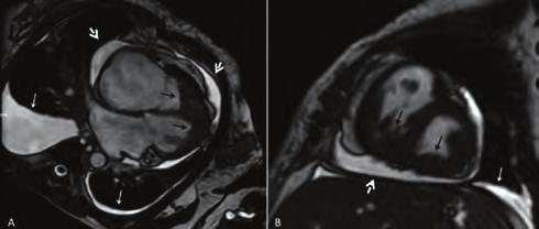 46 year-old woman was referred to us for investigation of class 3-4 dyspnoea. She had history of chronic renal failure due to IgA nephropathy with hemodialysis 3 times per week.