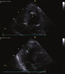 A clinical diagnosis of hypertrophic cardiomyopathy is confirmed when unexplained increased l left ventricle wall thickness of 5 mm is imaged.