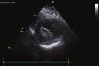 Here we are presenting a rare case of atypical hypertrophic cardiomyopathy. A 7-year-old man presented to the outpatient clinic with a complaint of non specific dypsnea.