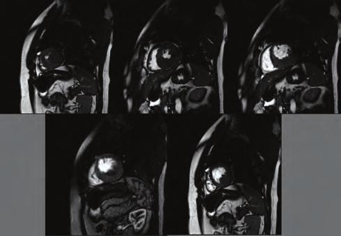 Dynamic and contrasted MRI series did not showed abnormal contrast enhancement so MRI views were evaluated as compatible with hypertrophic cardiomyopathy.