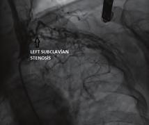 Kardiyak görüntüleme / Ekokardiyografi Kardiyak görüntüleme / Ekokardiyografi nected right dorsally aorta is abnormal development, Retroesophageal subclavian artery occurs.
