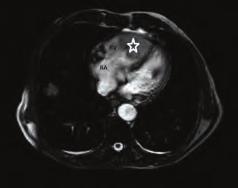 Cardiac MR showed large mass in the right ventricüle.