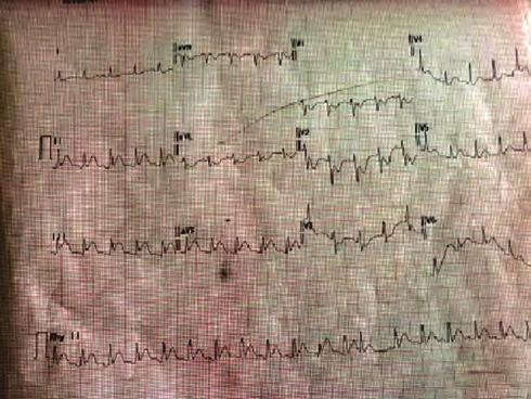 Efor kapasitesi NYHA (New York Heart Association) sınıf II idi. Fizik muayenede mitral odakta diastolik üfürüm mevcut ve akciğer sesleri normal idi.