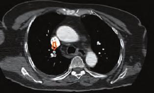 Ekokardiyografide sol atriyum içerisinde atriyumu ikiye bölen fibromusküler membran mevcut olup (Şekil ), pulmoner hipertansiyon (PABs:50 mm Hg) anomaliye eşlik ediyordu.
