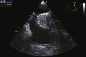 Şekil 5. Transözefagial renkli doppler görüntü. Şekil 6. Transözefagial ekokardiyografik görüntü. Transözefagial renklidoppler görüntü. Şekil 5.