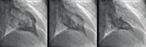 -D echocardiography revealed LV ejection fraction as 7.7%, with no significant valvular disease. We measured thickness of septal and posterior wall (PW) as 9 and mm.