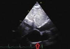 Because extracardiac mass detected by TTE required advanced examination for etiology, CT was applied to the patient to evaluate thoracic cavity.