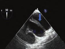 arrows). Figure. Transthoracic echocardiogram in the apical four chamber view showing a cystic mass visible under the right atrium (arrow). Figure 3.