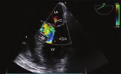 Kardiyak görüntüleme / Ekokardiyografi Kardiyak görüntüleme / Ekokardiyografi OPS-03 A rare cause of severe dynamic left ventricular outflow tract obstruction in an asymptomatic patient with