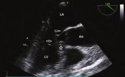 inherited cardiovascular disease having wide phenotypic expression.