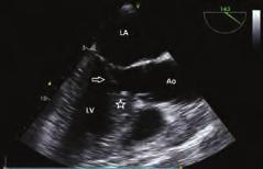 LVOT obstruction is result of a complex interaction of ventricular septum, mitral valve and subvalvular apparatus.