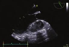 We report a case of primary cardiac sarcoma presenting with dyspnea due to mitral valvuler obstruction.