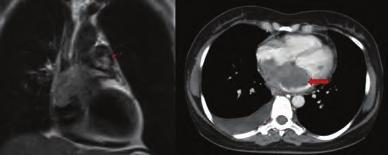 Magnetic resonance imaging of the lung was performed to find the origin of the metastatic tumor. A 8.6x5.3x5. cm mass filling the right and left atria was detected.