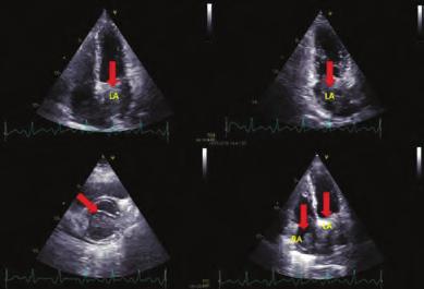 Transthoracic echocardiography was performed. A mass in the left and right atrium was detected. It was filling the left atrium.