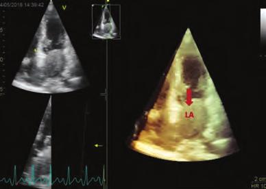 Mild mitral insufficiency was detected. The patient was evaluated with the department of oncology and cardiovascular surgery. It was decided that the mass was inoperable.