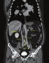 Pulmoner hipertansiyon / Pulmoner vasküler hastalık Pulmoner hipertansiyon / Pulmoner vasküler hastalık A B C Figure. (A-C) Curved multiplanar reformatted computed tomography image.