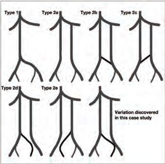 CTPA showed filling defects in the bilateral main pulmonary arteries consistent with acute bilateral pulmonary embolism (Figure, 3).