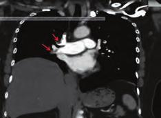 Computed tomography pulmonary angiography demonstrating a filling defect in the pulmonary artery consistent with pulmonary embolism (arrow). Figure.