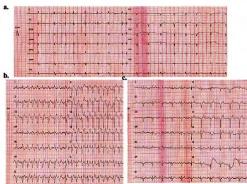 Aritmi / Elektrofizyoloji / Pacemaker / CRT-ICD Aritmi / Elektrofizyoloji / Pacemaker / CRT-ICD Tartışma: Cepte hap tedavi rejimi paroksismal atriyal fibrilasyonda sinüs ritmine çevirmede etkinlik ve