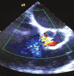 Department of Cardiology, Giresun University Faculty of Medicine, Giresun Introduction: Persistent left vena cava superior (PLSVC) is a rare congenital anomaly which is usually asemptomatic and poses