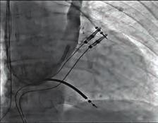 A bridging innominate vein may or may not be present. Venography is usually performed before cardiac device implantation in order to check patency of subclavian vein.