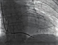 Physicians generally focus on the patency of the subclavian vein rather than its course.