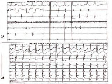 had NHYA class II-III symtomps despite optimal medical therapy. Venography was performed as a part of our routine practice in order to explore the patency of the subclavian vein.