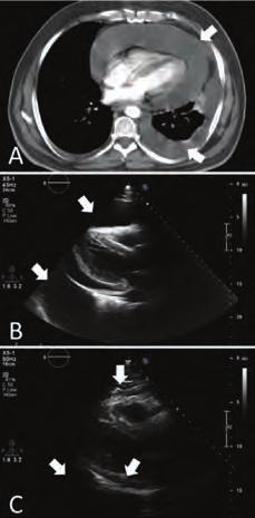 Aritmi / Elektrofizyoloji / Pacemaker / CRT-ICD Diğer OPS- A life threatening combination: Indomethacin and dabigatran Adem Adar, Orhan Önalan, Fahri Çakan Department of Cardiology, Karabük