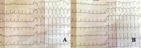 In this report, A 50-year old male patient has been presented involving the development of massive pleuropericardial effusion as a result of adding indomethacin to the dabigatran treatment for deep