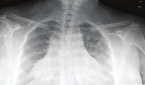 Dışkapı Yıldırım Beyazıt Eğitim ve Araştırma Hastanesi, Kardiyoloji Klinigi, Ankara Giriş: Kardiyak defibrilatör ve pacemaker gibi cihaz implantasyonunun genişleyen yeni endikasyonları ile birlikte