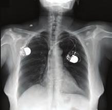 uzandığı izlendi (Şekil 3). Bunun üzerine pacemaker elektroduna bağlı ventrikül perforasyon öntanısı ile hastaya bilgisayarlı tomografi (BT) çekildi ve tanı doğrulandı (Şekil 4).