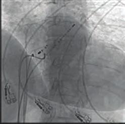 500/30 msn de tekli atrial ekstra stimulus ile septal bölgede VA mesafesi <70 msn olan dar QRS li taşikardi indüklendi (Şekil ). Ventriküler overdrive pacing yapıldı.