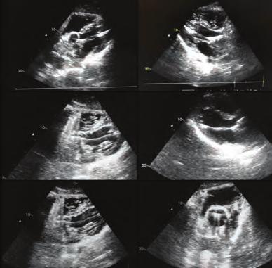 Aritmi / Elektrofizyoloji / Pacemaker / CRT-ICD Aritmi / Elektrofizyoloji / Pacemaker / CRT-ICD Atriyal fibrilasyonlu hastaların çoğunluğunda tromboembolik olaylardan korunmak için antikoagulan