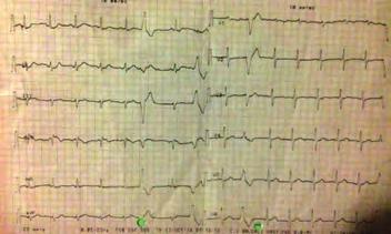 His physical examination was normal. Electrocardiography revealed sinus rhythm with a QS pattern and mm ST segment elevation in the V-V6 leads.