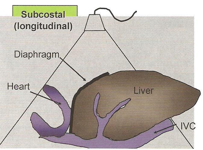 Inferiyor Vena Kava Yüksek parasagittal bakı 2-3 cm