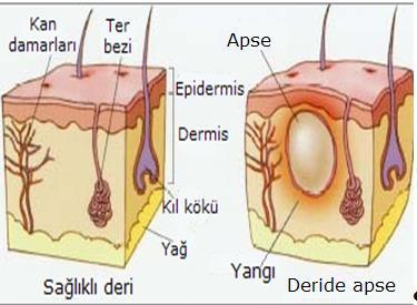 Apse (çıban): Apse, deri altında irin birikmesidir. Bakteri enfeksiyonlarına karşı vücudun verdiği bir reaksiyondur.