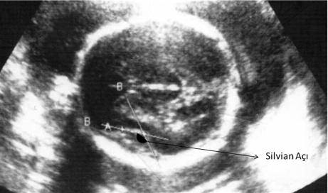 b) Silvian fissür tabanı olarak ölçülen düz çizgi ile temporal lobun taban üzerine kıvrımlanmasını gösteren arka taraftaki hiperekojen çizgi arasındaki açı Silvian fissür açısı olarak ölçülmüştür.