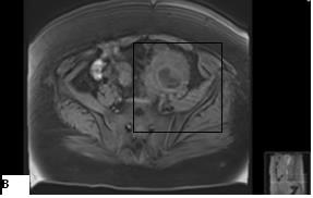 [1,2] Klinikte serviko-fasiyal, abdominal, pelvik, torasik ve çok ender serebral kütanöz türleri ile karşımıza çıkmakta, belirti bulgular yönünden fungal enfeksiyonlar ve malignite ile karıştırılarak