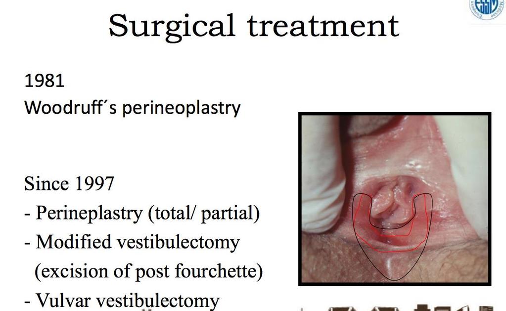 Cerrahi Tedavi 1981 Woodruff s perinoplasty 1997 den beri Perineplasty